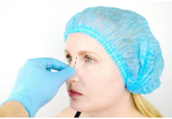 Affordable Rhinoplasty Expert Beverly Hills